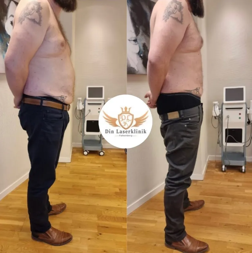 Före och efter EMS-behandling av mage hos en man, sedd från sidan