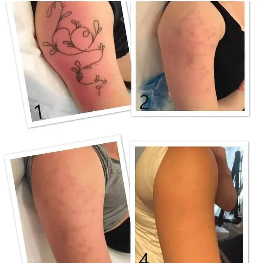 Fyra bilder som visar hur en tatuering på överarmen bleknar efter varje behandling