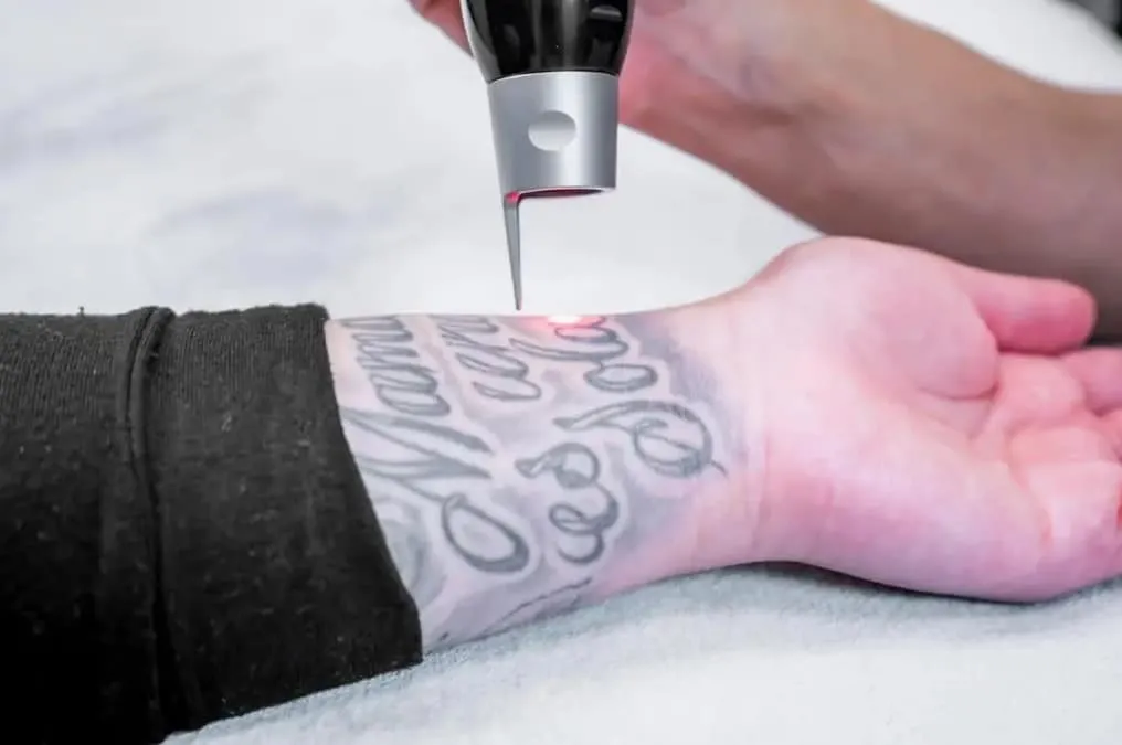 Laser som behandlar en tatuering på handleden